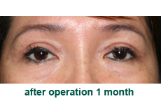 plastic-surgery-blepharoplasty